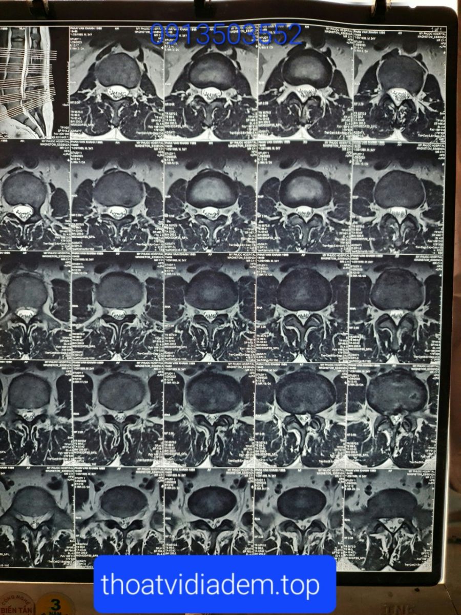 MRI thoát vị đĩa đệm trên phim